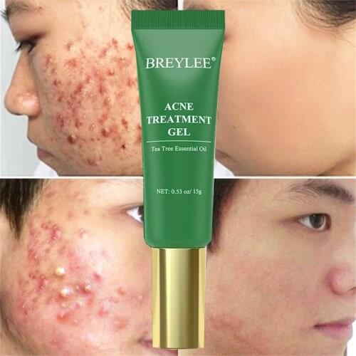 BREYLEE Acne Removal Cream Tea Tree Anti-acne Gel Remove Pimple Repair Fade Acne Spots Oil Control Moisturizing Face Skin Care