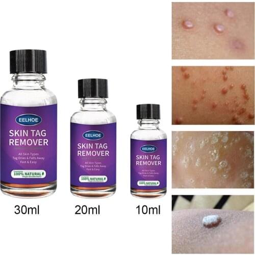 Genital Warts Removal Antibacterial Liquid Foot Calluses Cream Treatment Wart Corn Skin Care Flat Medical Skin Meat Relief O0Y0