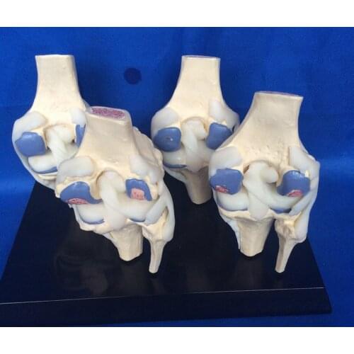 1:1 Life Size Human Knee Joint Model 4 Stage Knee Joint Disease Model Skeleton Model Anatomy Skull Medical Teaching Models