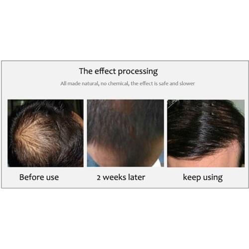 Ginger Hair Growth Essence Spray 20ml Hair Grow Restoration Oil Prevent Baldness EF