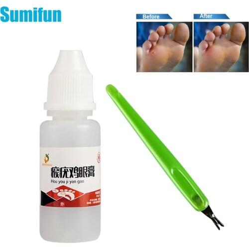 10g Corn Treatment Liquid Ointment Remove Exfoliator Feet Calluses Removal Warts Thorn Medical Oil Soften Skin Cutin Foot Care