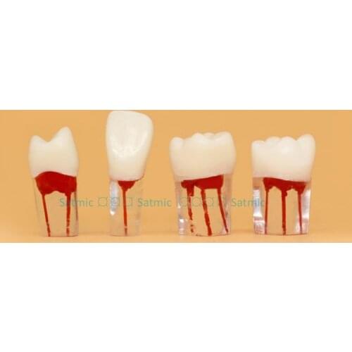 4pcs/lot Tooth Root Canal Model for RCT Practice Transparent Resin with Pulp Cavity & Dyed Root Canal