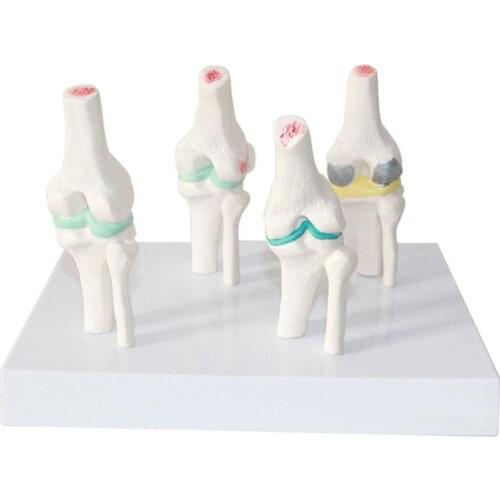 Anatomical Human Degenerative Knee Joint Disease Model Medical Skeleton Anatomy Teaching Resources