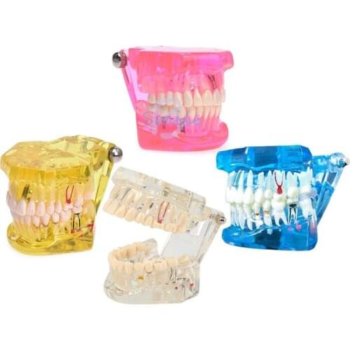 New Arrivel Dental Implant Teeth Model With Restoration Bridge Tooth For Dental Disease Teaching Study