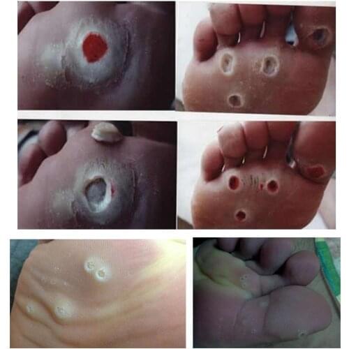 Foot Corn Killer Calluses Plantar Warts Thorn Pain Protector Relief Sticker Plaster Care Foot Toe Medical Tool K5T4