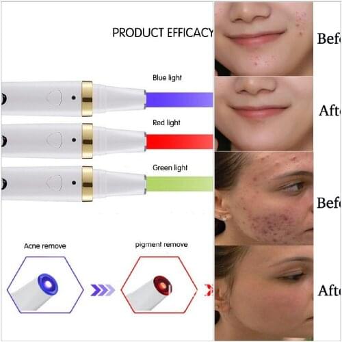 Bio acne removal pen acne laser pen with topical heating and led blue light therapy acne treatment pimple remover