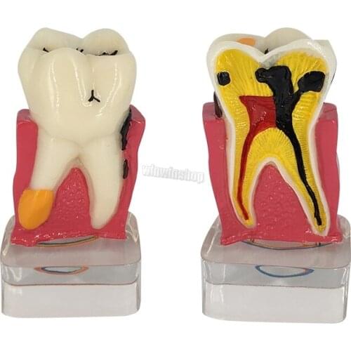 1Pcs Oral dental model 4 times transparent molar profile model with nerve For Dental Lab