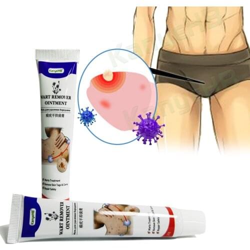2pcs Wart Remover Ointment Genital Condyloma Acuminatum Dedicated Cream Genital Penis Herpes Wart Remover Treatment Cream A634