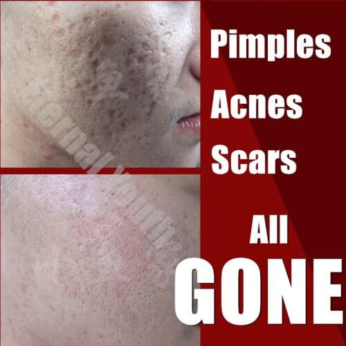 New 3 in 1 Acne Spot Pimple Treatment Natural Herbal Cream 3Days Pimples Removal Set