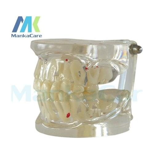 Manka Care - Milk teeth alternating model Dental Teeth Model with Restoration Bridge Tooth Dentist for Medical Science Teaching