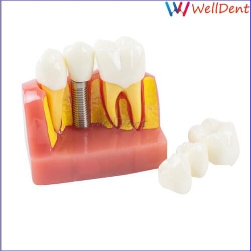 Dental Teeth Tooth Model Demonstration Implant Analysis Crown Bridge Dental Materials Dentist