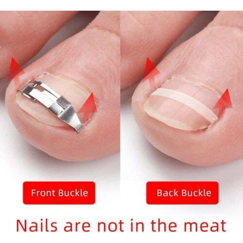 1 Pair Ngrown Toenail Corrector Orthotic Nail Fixer Feet Care Care Toenail Treatment Correction Foot Tools Pedicure Recover P9L5