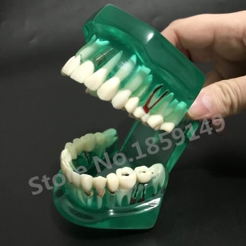 Dental Implant Disease Teeth Model with Restoration Bridge Tooth Dentist for Medical Science Teaching 1pc