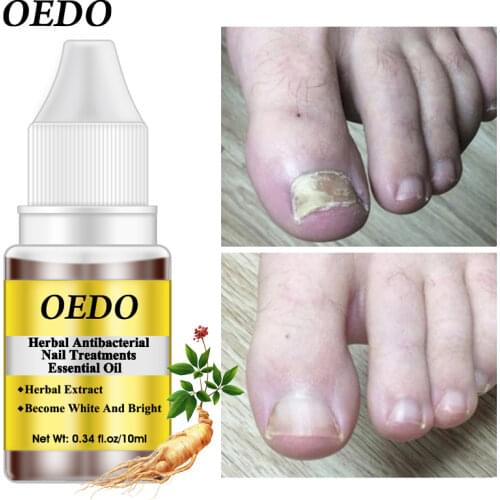 Herbal Antibacterial Nail Treatments Essential Oil Herbal Extract Nail Fungus Art Repair Tools Foot Nail Care Repair Serum