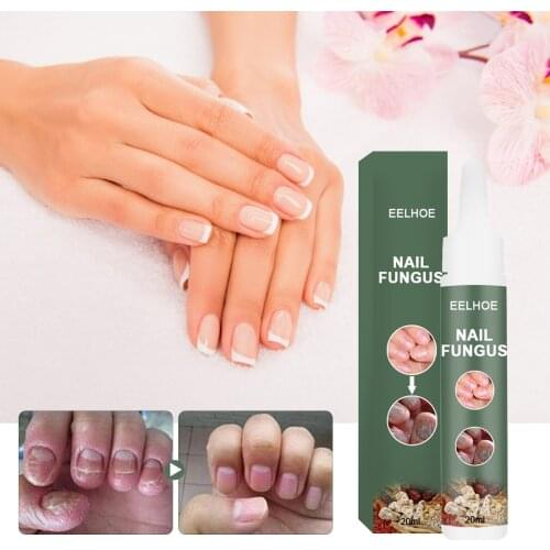 20ml Effective Fungal Nail Treatments Essences Serum Onychomycosis Paronychia Anti-Fungal Nail Infective From Nail Fungus Foot