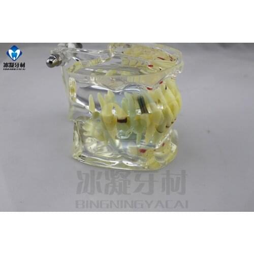 Dental teeth Adult pathology model Doctor-patient communication The demo model Dental caries free shipping
