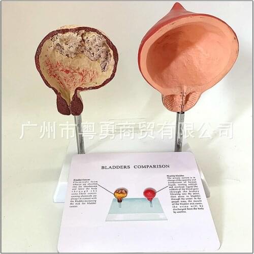Smoking bladder and healthy bladder Comparative model Pathological bladder Anatomy of bladder reproductive system bladder