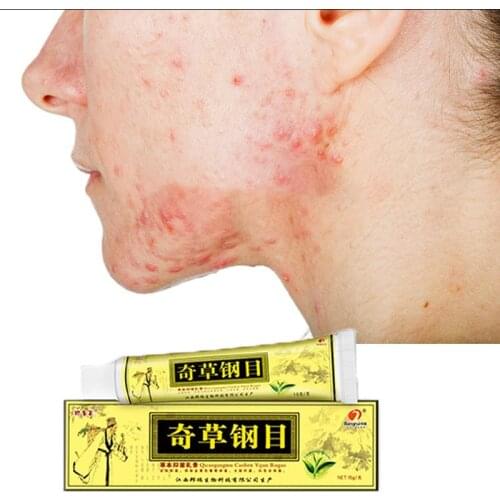 Dropshipping 15g QICAOGANGMU Skin Psoriasis Cream Dermatitis Eczematoid Eczema Ointment Treatment Psoriasis Cream