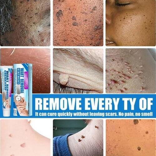 Wart Removal Cream 20g Warts Remover Ointment Wart Plaster Extract Tag Ointment Corn Skin Warts Herbal Remover Cream Treatm Q6C6