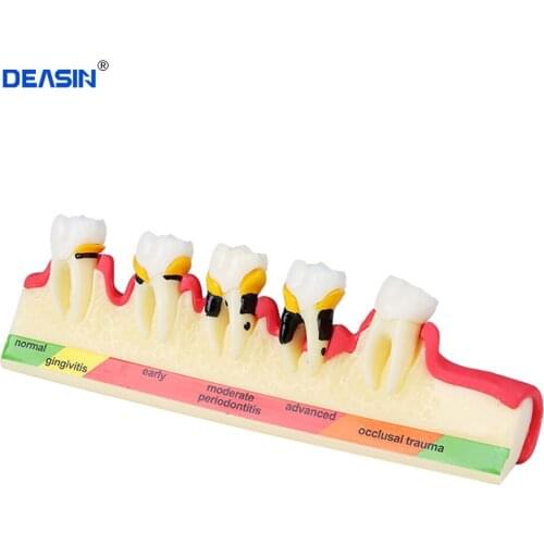 Dental Teeth Model Periodontal Disease Assort Tooth Classification Model