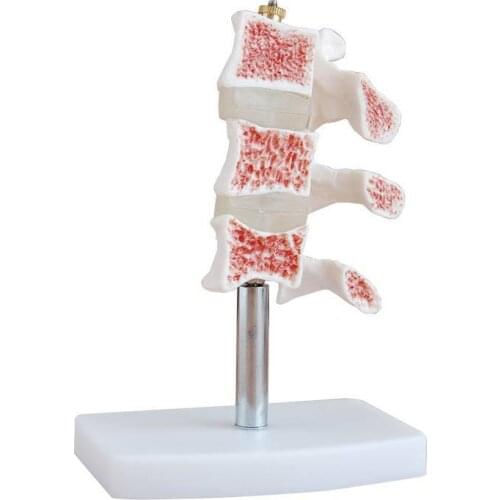 The spine Disease model Osteoporosis joints model
