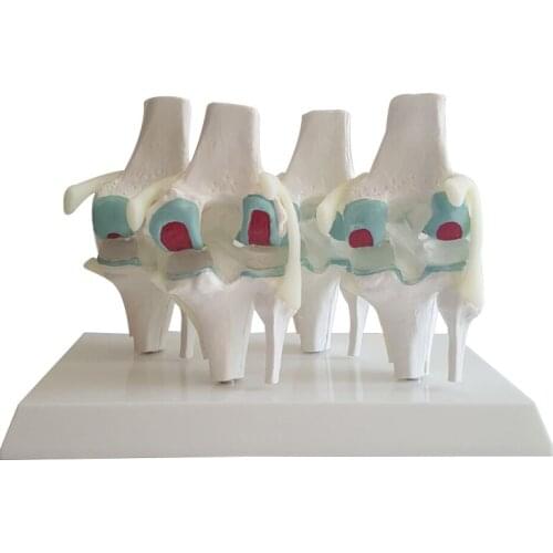 Anatomical Human Degenerative Knee Joint Disease Model Medical Skeleton Anatomy Teaching Learning Supplies Resources