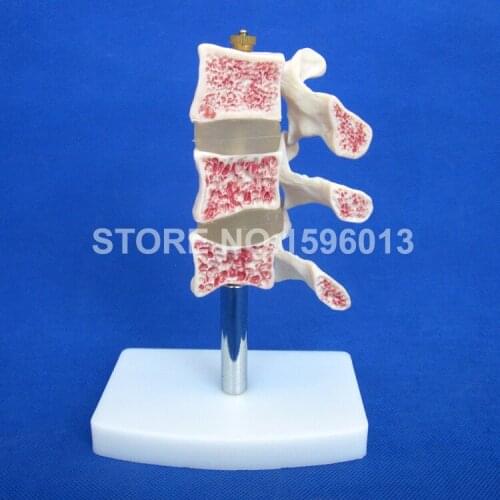 HOT Advanced Cutaway Osteoporosis Spine model, Lesions in the Lumbar Spine Model
