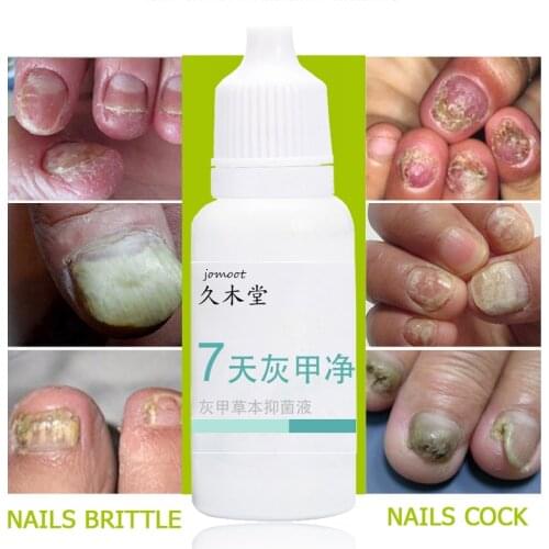 Nail Treatment Removal of onychomycosis Repair Gentle And Effective Treatment Onychomycosis Serum Nail Regeneration Gel 10ml