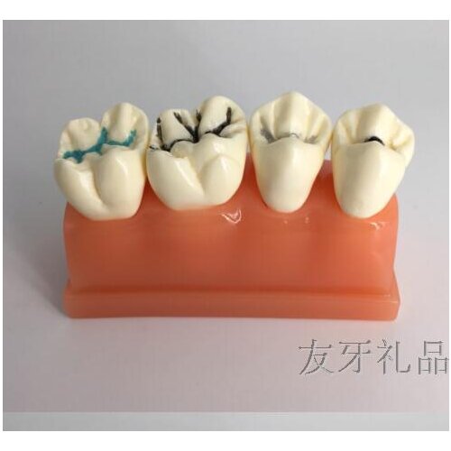 3Xnest ditch Closed models Tooth model Oral cavity model 10*5*6 Teeth are resin seat is crystal glue free shipping