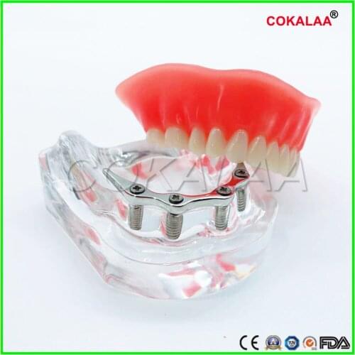 1 pcs Preparation model dental implant model dentures teeth model for dentists learning silver rod