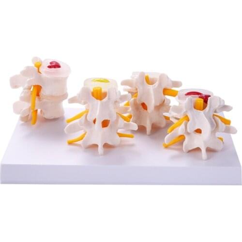 Human Anatomy Skeleton Spine 4-Stages Lumbar Vertebral Model Brain Skull Traumatic Teaching Supplies