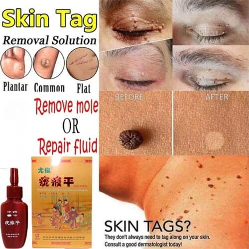 Skin Tag Remover Against Mole & Genital Wart fast RemovWithin al Anti Foot Corn Removal Warts Papillomas Rapidly removes moles