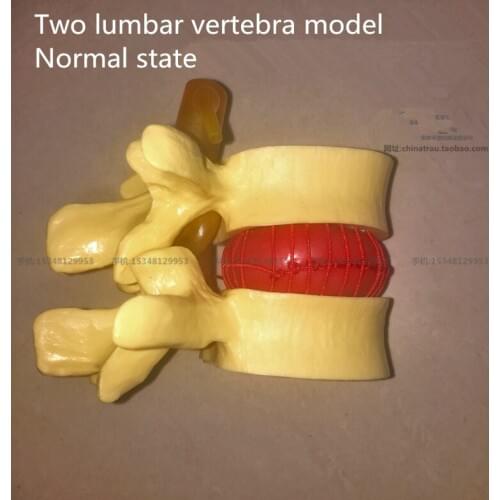 Medical Two lumbar vertebra model Normal state CMAM VERTEBRA12 Life-size Lumbar Vertebrae Models in 3 Stages of Degeneration
