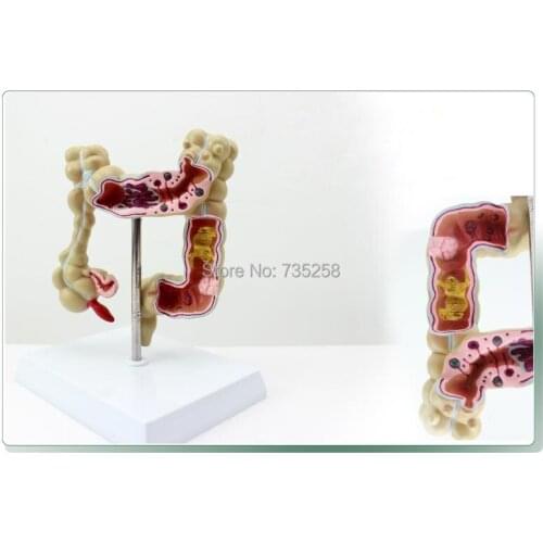Human Colon Disease Model,Lntestinal Anatomical Model,Colon Model