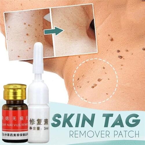 Non-Trace Removal Moles Potion Blackhead Remover 12 Hours Medical Fast Repair Skin Tag Mole Dark Spot Face Beauty Skin Care Tool