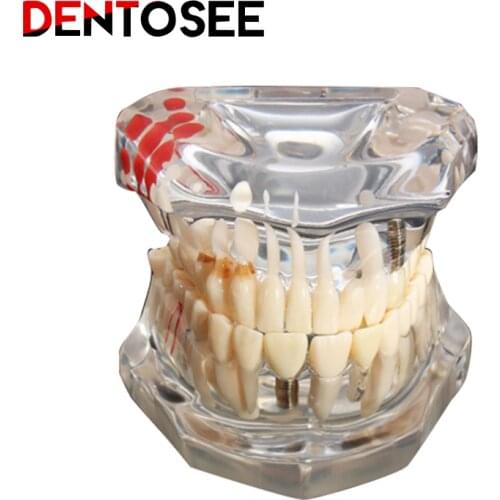 Standard Teeth Model-Dental Disease Teaching Study Adult Typodont Demonstration Teeth Model