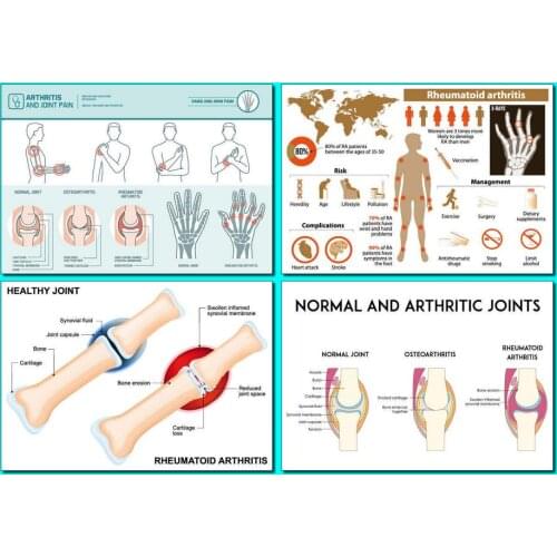 4style Choose EDUCATIONAL ARTHRITIS Art Film Print Silk Poster for Your Home Wall Decor 24x36inch