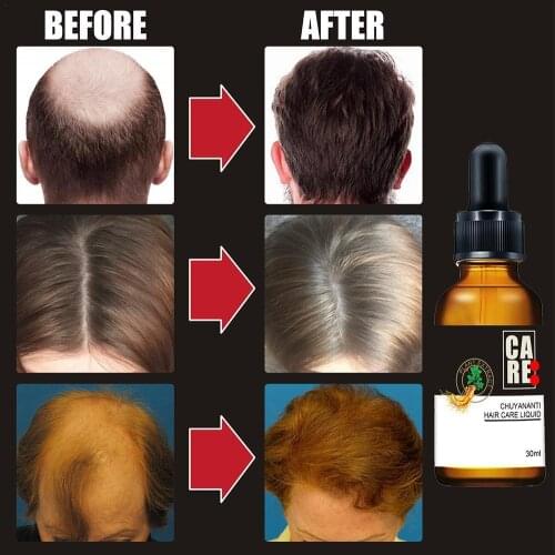 Hair Growth Oil Essence Thickener For Hair Extract Growth Growth Hair Hair Natural Product Treatment Loss Plant Product P9J0