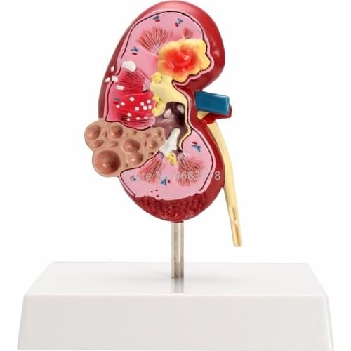 "1Pc Kidney Anatomical Model 2- sided Diseased Anatomy Medica l glomerulus kidney nephron r enal Anatomical Model"