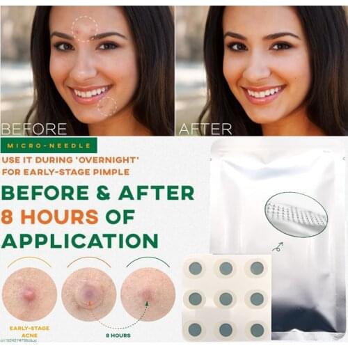 9 Patches Microneedle Acne Pimple Healing Patch Anti Acne Pimple Patch Soothing Face Skin Healing Zit Stickers Blemish Treatment