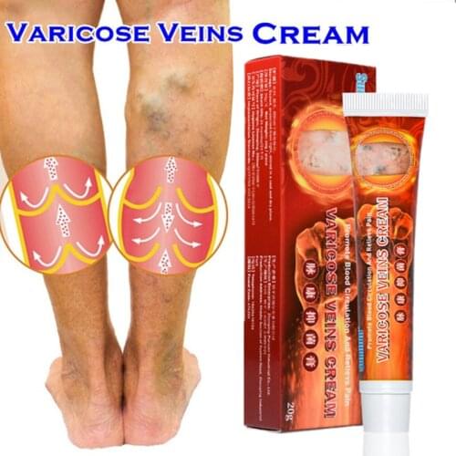 Varicose Veins Treatment Cream Varicosity Angiitis Remedy Ointment Spider Veins Pain Relief Phlebitis Legs Medical Herbal Cream