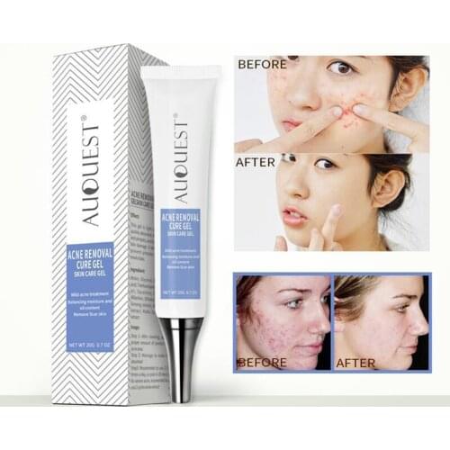 Acne Removal Cure Gel Scar Marks Acne Treatment Repair Cream Comedone Pimple Cleaning Blackhead Remover Skin Care