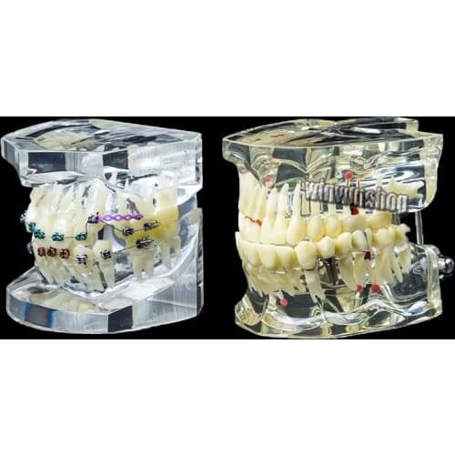 1PC Dental Orthodontic Study Model Transparent Teeth Malocclusion Orthodontic Model with Metal Brackets Brace