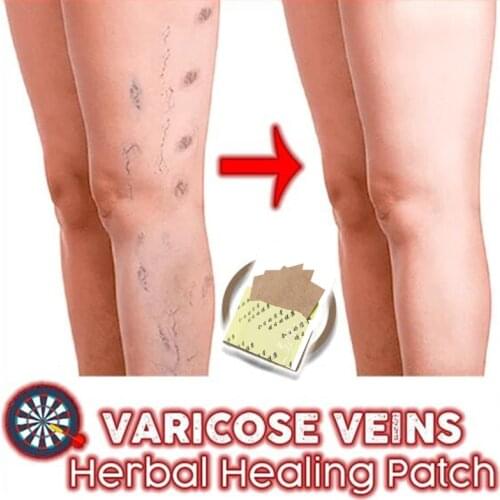 6 Patches Spider Veins Varicose Treatment Plaster Varicose Veins Cure Patch Vasculitis Natural Solution Herbal Patche