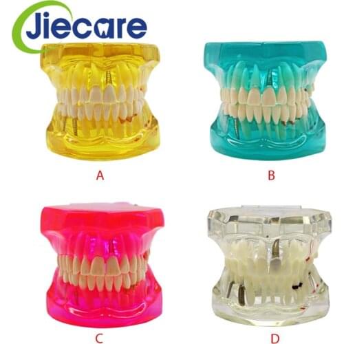 1 PC Dental Implant Disease Teeth Model With Restoration Bridge Tooth Dentist For Medical Science Dental Disease Teaching Study