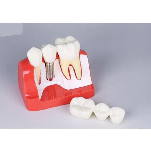 Dental implant model M2017R /oral cavity implant teaching model M2017RWith Fixtures and Bridge Dental Study Teeth Model