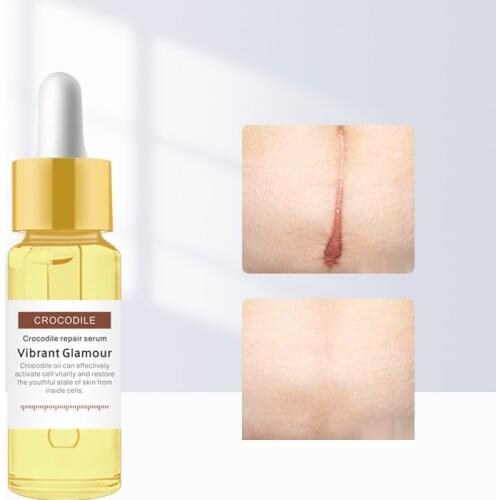 Acne Scar Removal Face Serum Dispel Pimples Stretch Marks Remove Acne Treatment Smoothing Whitening Moisturizing Body Skin Care