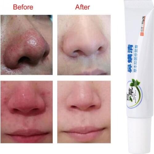 Rosacea Treatment Cream Nose Redness Removal Cleaning Antibacterial Gel Red Nose Blackhead Remover Skin Care Product