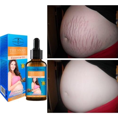 Snail Stretch Marks Remover Essential Oil Skin Care Treatment Cream For Stretch Mark Removal Maternity Slackline Pregnant Oils