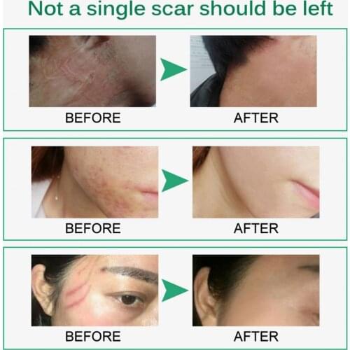 Scar Cream Beauty Skin Repair Cream External Use Skin Nourishing No Additive Scar Skin Stretch Mark Treatment